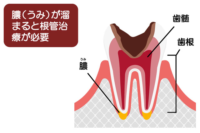 根管治療が必要になった歯