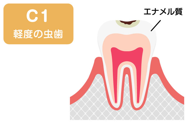 虫歯の進行度 C1段階
