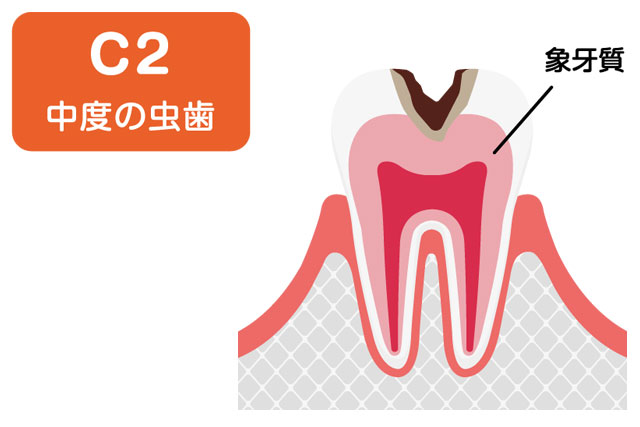 虫歯の進行度 C2段階