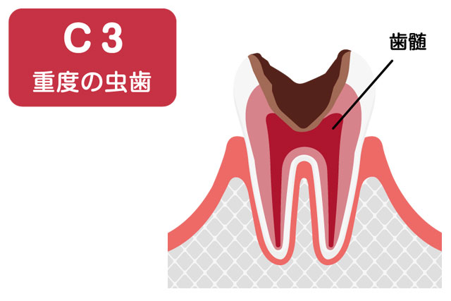 虫歯の進行度 C3段階