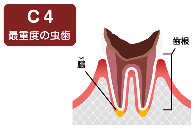 虫歯の進行度 C4段階